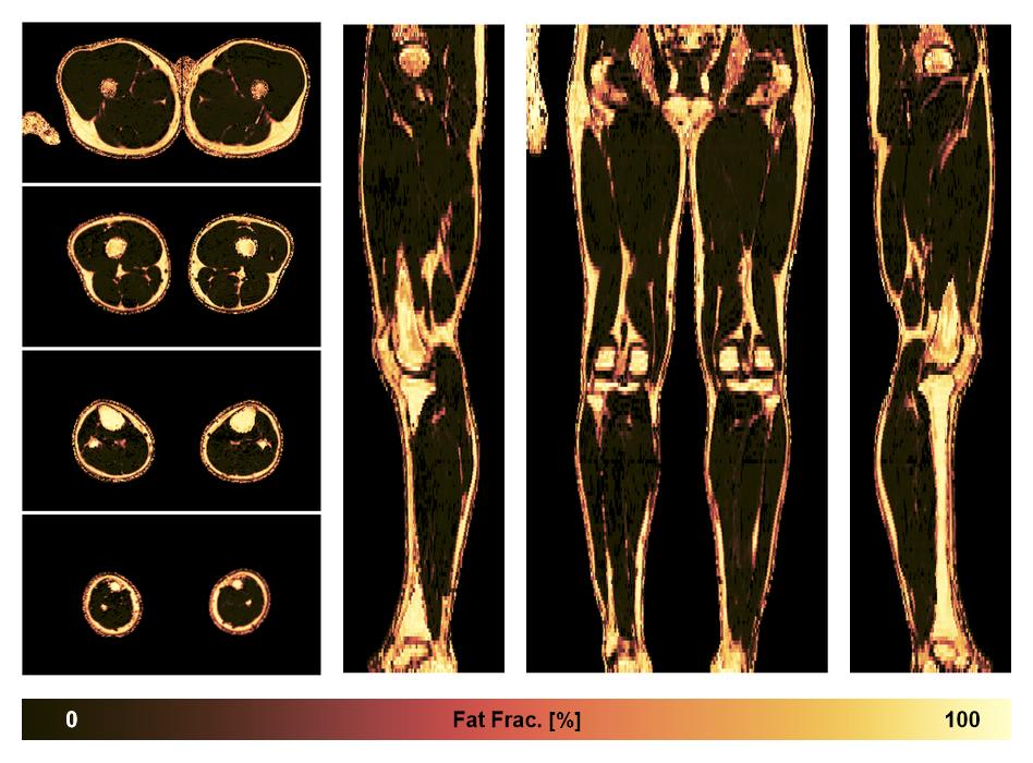 The fat fraction of the lower extremity obtained from the dixon reconstruction for muscle water fat quantification.